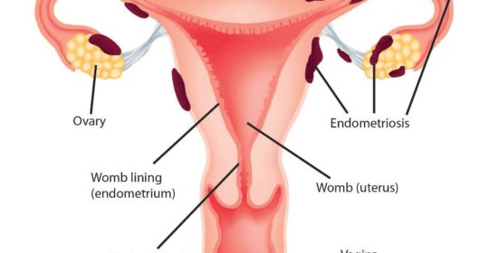 GROTTAGLIE. Marzo è il mese dell’endometriosi, Sud in Movimento in campo per aumentare la consapevolezza